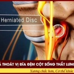 Thoát vị đĩa đệm cột sống thắt lưng: Biểu hiện, Hậu quả và Cách điều trị hiệu quả