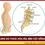 Tìm hiểu về đau lưng do thoái hóa đĩa đệm cột sống